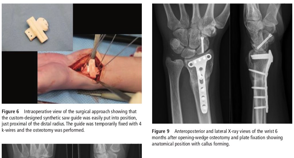 Lars Brouwers, MD, PhD, MSc (@brouwers_3d) on Twitter photo #3Dprinting in traumasurgery, a low cost workflow. Today we present our results in <a href="/BMJCaseReports/">BMJCaseReports</a>. the first step to prove that 3Dprinting can be cost-effective. <a href="/Til_Surg/">Chirurgen Tilburg</a> <a href="/ETZnl/">ETZ</a> <a href="/radboudumc/">Radboudumc</a> @3DLabNijmegen <a href="/physicianswkly/">Physician's Weekly</a> <a href="/JanWitowski/">Jan Witowski</a> <a href="/Ultimaker/">UltiMaker</a> <a href="/JayMorris_MD/">Jay Morris</a> <a href="/Oceanz3Dprint/">Oceanz.</a> #3Dprinting in traumasurgery, a low cost workflow. Today we present our results in <a href="/BMJCaseReports/">BMJCaseReports</a>. the first step to prove that 3Dprinting can be cost-effective. <a href="/Til_Surg/">Chirurgen Tilburg</a> <a href="/ETZnl/">ETZ</a> <a href="/radboudumc/">Radboudumc</a> @3DLabNijmegen <a href="/physicianswkly/">Physician's Weekly</a> <a href="/JanWitowski/">Jan Witowski</a> <a href="/Ultimaker/">UltiMaker</a> <a href="/JayMorris_MD/">Jay Morris</a> <a href="/Oceanz3Dprint/">Oceanz.</a>