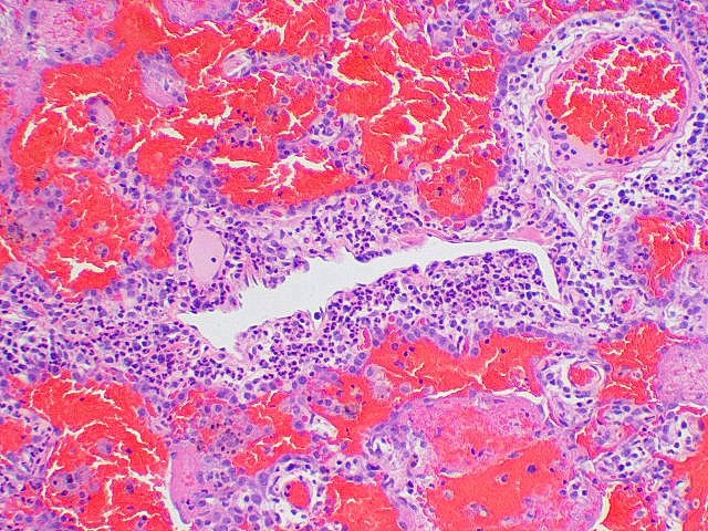 Pulmonary #capillaritis and acute hemorrhage in an infant attributed to #milkallergy
#pulmpath #pathology