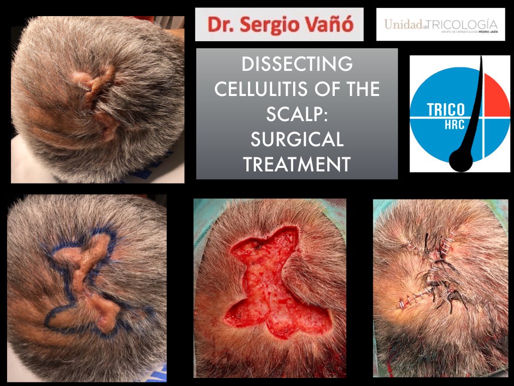 SergioVanoG's tweet photo. Some cases of #DissectingCellulitis of the scalp may require surgical treatment to improve the symptoms of the disease.
#tricoHRC #tricologiaGPJ #dermatology #cicatricialalopecia #alopecia #hair #hairresearch #trichology #grupopedrojaen 
https://t.co/qTnCXNDHfA https://t.co/aYs0YNhYAm