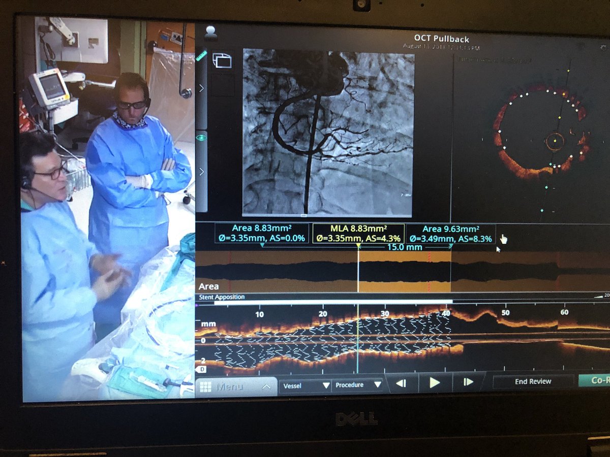 PrecisionPCI's tweet image. PCI Live webinar “How to Treat with Certainty” with Drs Schlofmitz and Jeremias. Great demonstration of #PCIoptimization and why #ImageFirst is so important. OCT tells the whole story. Hope you were able to join, #Cardiotwitter