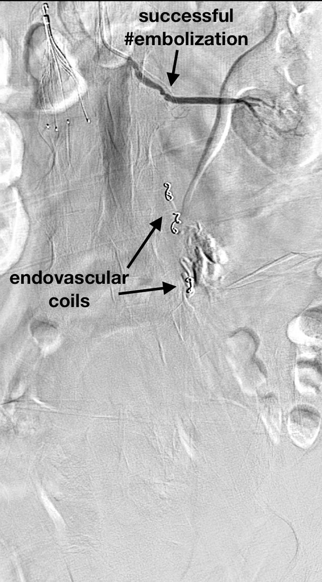 GuthrieIR (@guthrie_ir) on Twitter photo #radialfirst L gonadal artery #embolization for tx of malignant vaginal bleeding!
medium sized <a href="/MeritMedical/">Merit Medical</a> #embospheres and <a href="/BostonPIMedEd/">Boston Scientific PI MedEd</a> #interlock coils!
#irad
<a href="/SarelGaurMD/">@SarelGaurMD</a>
<a href="/joeirad/">Joe Ronsivalle</a>
<a href="/SimaBanerjeeMD/">Sima Banerjee</a> #radialfirst L gonadal artery #embolization for tx of malignant vaginal bleeding!
medium sized <a href="/MeritMedical/">Merit Medical</a> #embospheres and <a href="/BostonPIMedEd/">Boston Scientific PI MedEd</a> #interlock coils!
#irad
<a href="/SarelGaurMD/">@SarelGaurMD</a>
<a href="/joeirad/">Joe Ronsivalle</a>
<a href="/SimaBanerjeeMD/">Sima Banerjee</a>
