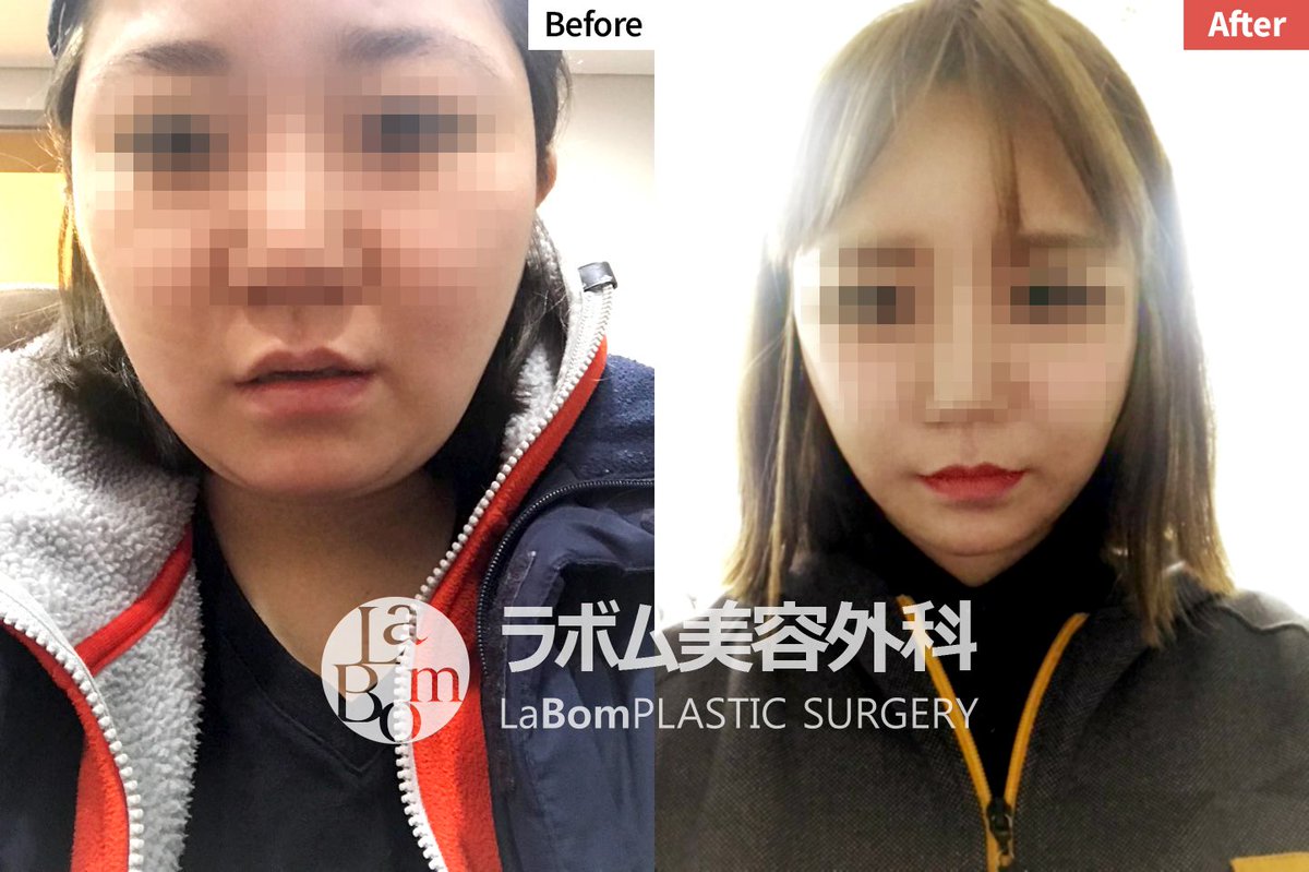 ラボム整形外科 A Twitter ラボムの切開リフトの症例写真です 老化でたるんだ人 輪郭後たるみができた人 首のたるみまで改善したい人に 切開リフトをお勧めします お問い合わせはこちらまでお願いします ホームページ T Co 2osci2l48s Line Labomps