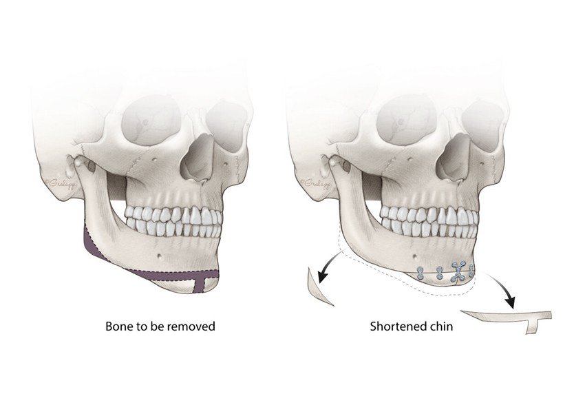 psdivya1267's tweet photo. #Genioplasty is the chin #augmentation using surgical #implants which alter the underlying structure of the #face,providing better balance to the facial features. This may be of advancement, pushback, side to side or vertical.
Know more on #Dentistry @ Dental Science 2018| London https://t.co/fhJiAih2FE