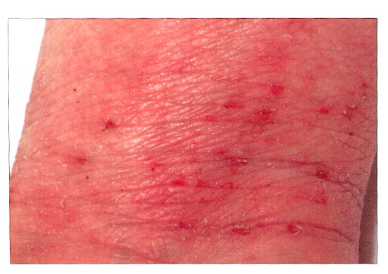 ckbridgett's tweet photo. #EczemaExplained 🤔Will #HabitReversal help with my #eczema?
😀Yes, if you have chronic atopic eczema: the skin is then typically thickened and rough, #lichenification. 💡But only combined with optimal topical treatment too! See...
https://t.co/Lkhh9kDUQj https://t.co/vXGNsEhSVn
