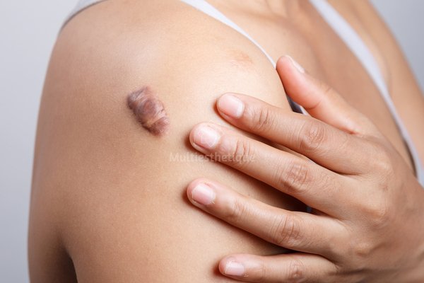 multiesteticafr's tweet photo. Chéloïde et piercing : quel traitement ? https://t.co/NuiGKmENHI https://t.co/ke5WgFl3hj
