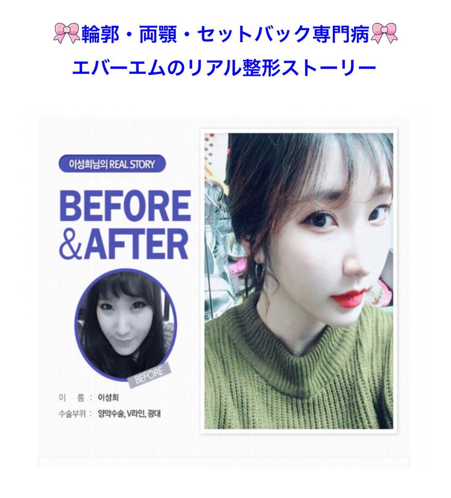 Sovely Twitter પર エバーエムの両顎 Vライン 頬骨縮小症例です 面長 しゃくれ顎 顔の歪み改善 エバーエム 韓国整形 韓国両顎手術 韓国輪郭手術 頬骨縮小 Vライン手術 韓国両顎手術 韓国両顎手術 韓国整形通訳 ルフォー セットバック T Co
