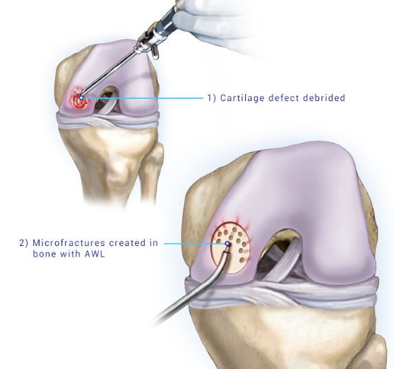 bethshubinstein's tweet photo. Surgical Treatments for Damaged Cartilage
Click below to learn about Microfracture, DeNovo, OCA (Osteochondral Allograft), and MACI surgical treatments for damaged cartilage:
https://t.co/lobueHVgF5
#damage #cartilage #injury #kneeinjury #kneecapdislocation
#painmanagement https://t.co/fqRJiiwRUu