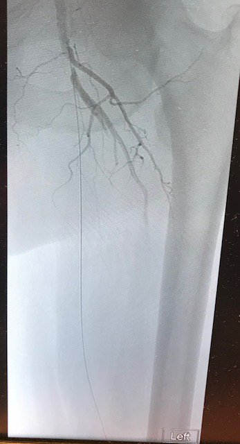 bsc_vascular's tweet photo. Completely occluded SFA opened with Jetstream 2.4/3.4 followed by 3 DCB's - TY for sharing this great case Dr. Strnad #PAD #Atherectomy #VesselPrep https://t.co/ghATeWnL4U