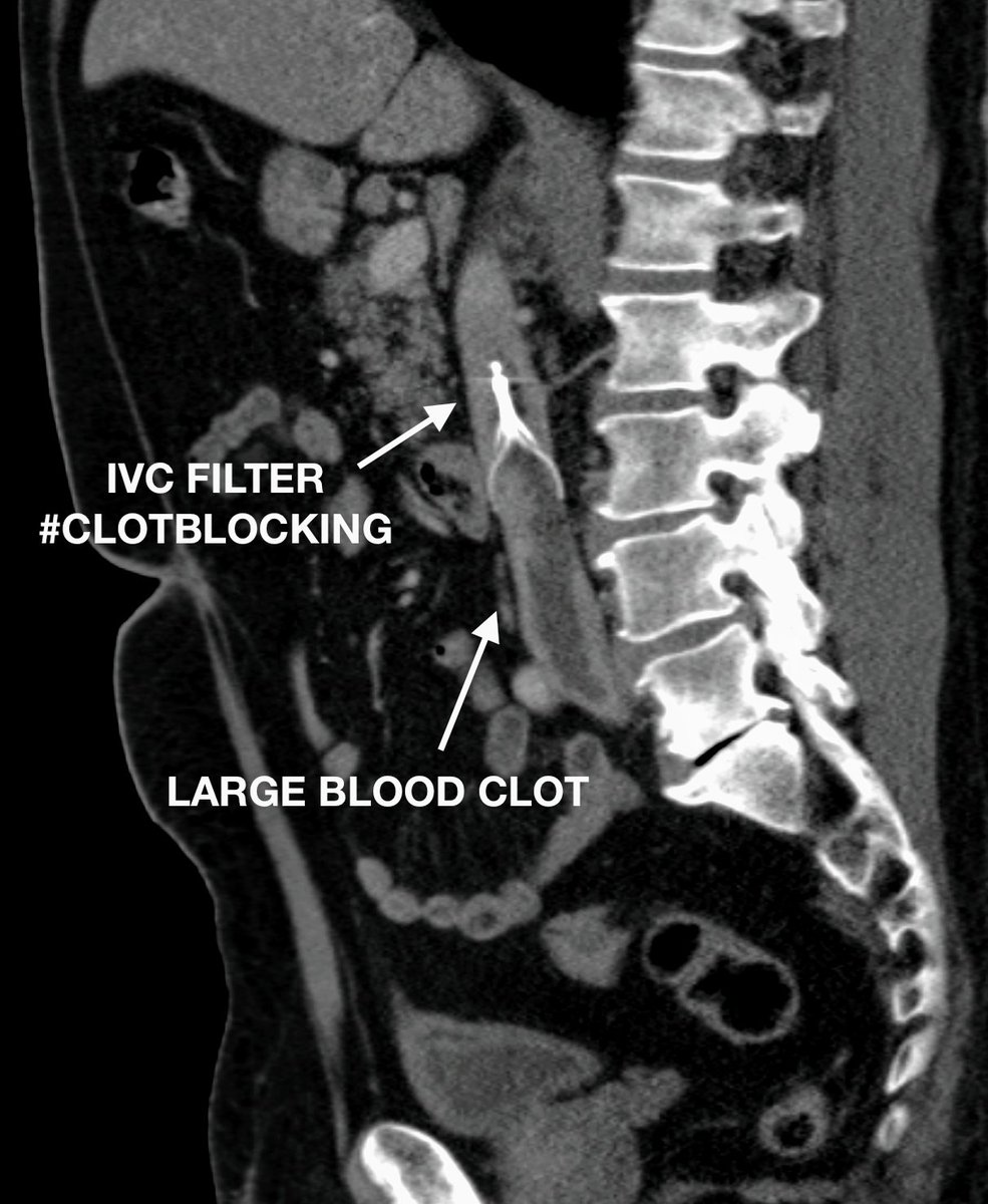 @SarelGaurMD (@sarelgaurmd) on Twitter photo picture proof that <a href="/CookMedical/">Cook Medical</a> #IVCFilters prevent #pulmonaryembolism / #PE and save lives! Not news to the #irad physicians who place them
#clotblocking
#radiology
<a href="/SimaBanerjeeMD/">Sima Banerjee</a>
<a href="/joeirad/">Joe Ronsivalle</a>
<a href="/VinayPrasadMD/">Vinay Prasad</a> picture proof that <a href="/CookMedical/">Cook Medical</a> #IVCFilters prevent #pulmonaryembolism / #PE and save lives! Not news to the #irad physicians who place them
#clotblocking
#radiology
<a href="/SimaBanerjeeMD/">Sima Banerjee</a>
<a href="/joeirad/">Joe Ronsivalle</a>
<a href="/VinayPrasadMD/">Vinay Prasad</a>