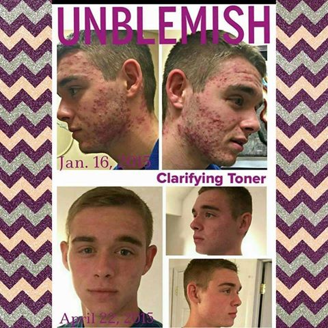 eb1983daly's tweet photo. The Unblemish regimen by Rodan and Fields works for both guys and gals.  I can help you help your teen be ready for school.
https://t.co/ZPWpniCRT2 https://t.co/URLdYWyLN1
