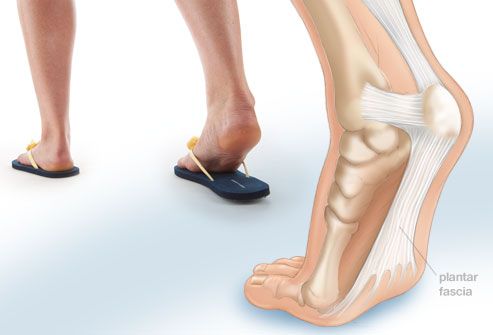 AltumHealth's tweet photo. Walking barefoot, or in flimsy shoes without sufficient arch support, can overstretch, tear, or inflame your plantar fascia. https://t.co/OPSebK2SCV #Altumhealth https://t.co/T7Phwz1KpP