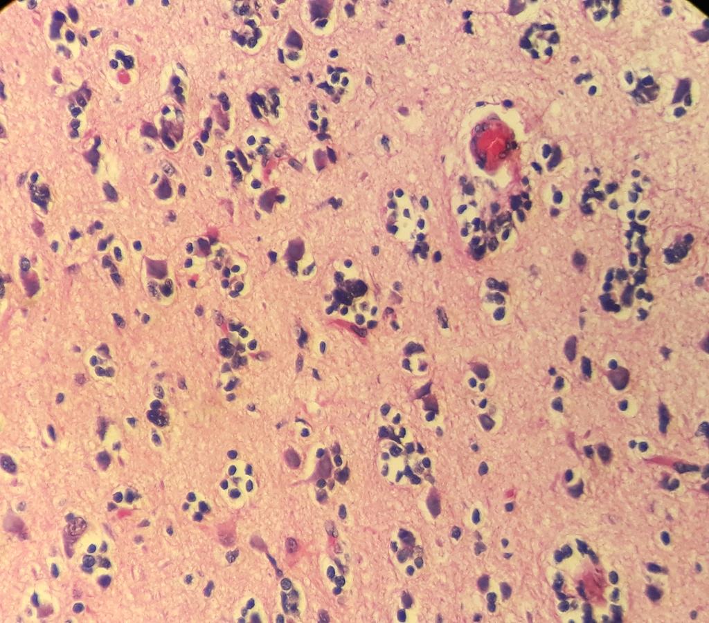 Secondary structures of Scherer (tumor cells of a diffusely infiltrating astrocytoma aggregate around pre existing structural elements like neurons,blood vessels ...)