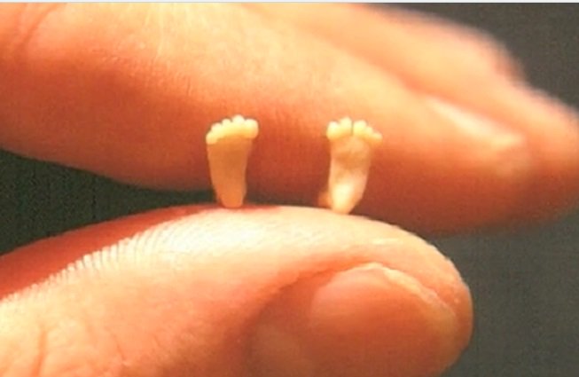 LiveAction's tweet photo. This image of the tiny feet of an aborted baby has been seen by millions.

It was photographed by a doctor who wanted to share the obvious humanity of the preborn.

It later became the image behind the iconic pro-life “Precious Feet” pin. 

Retweet this powerful photo. https://t.co/ynei4okCsL