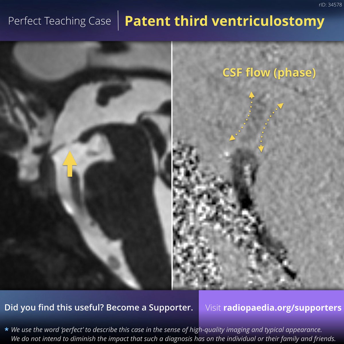 frankgaillard's tweet photo. Perfect teaching case: Patent third ventriculostomy (#MRI including #FlowStudies)
View Case: https://t.co/LgoKLFid13
Become a @Radiopaedia supporter: https://t.co/UOZ174KNzo
#SupportRadiopaedia #radiology #FOAMed #FOAMrad #neurorad #brain #CSF #neurosurgery https://t.co/FQWkfdF78K