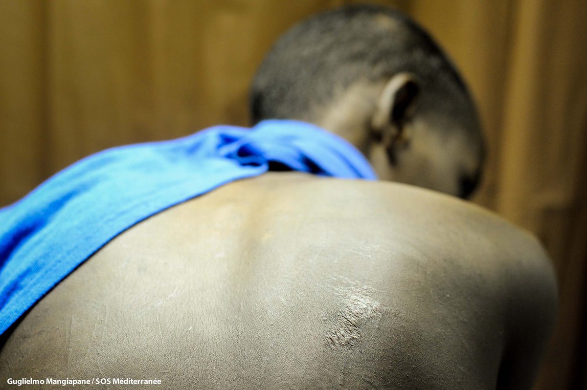 Some of scars #MSF medical team has seen on people rescued by #Aquarius. Many have suffered kidnap, torture and extortion in #Libya. We see results on their bodies: gunshot wounds, burned with lighters or knives held over a fire, boiling water poured on them, beaten with sticks.
