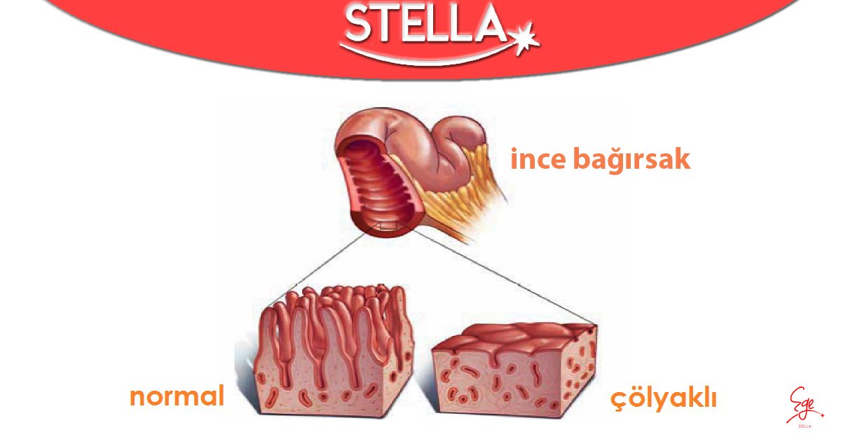 ege_stella's tweet photo. Çölyak, ömür boyu süren bir oto immün hastalığıdır ve bağırsak ile vücudun diğer bölümlerine etki eder. Vücudun bağışıklık sistemi gıdanın içerisinde bulunan glutene tepki verir. Gluten; buğday, arpa, çavdar ve yulafta bulunan bir proteindir.
#Glutensiz #GlutensizYasam #Çölyak https://t.co/cASoxQdq3j