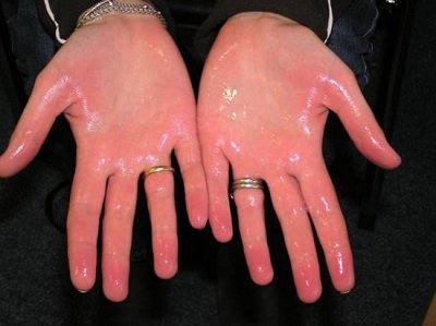 Afyon’da aşırı terlemeden şikâyet eden kimse kalmasın:
AŞIRI TERLEMEYE KAPALI AMELİYATLA SON
afsu.edu.tr/afyonda-asiri-…