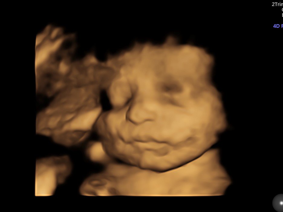 windowtothewomb's tweet photo. Absolutely Stunning Comparison of Baby in 4D &amp; HD* 💗 #4dscan #hdscan #baby #pregnancyscan #babyscan
*Availability of HD is Clinic Dependent https://t.co/U6CRXNcv0E