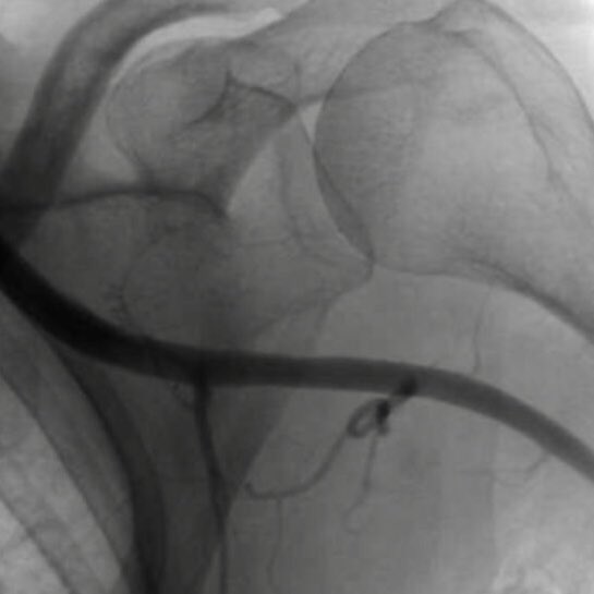 willsuh76's tweet image. #PercAx #TAVR. Single Perclose. Dry closure. Post angio showed mild extravasation.  Ten minutes manual pressure and repeat angio was pristine. No Perclose Pinch. No need for covered stent.