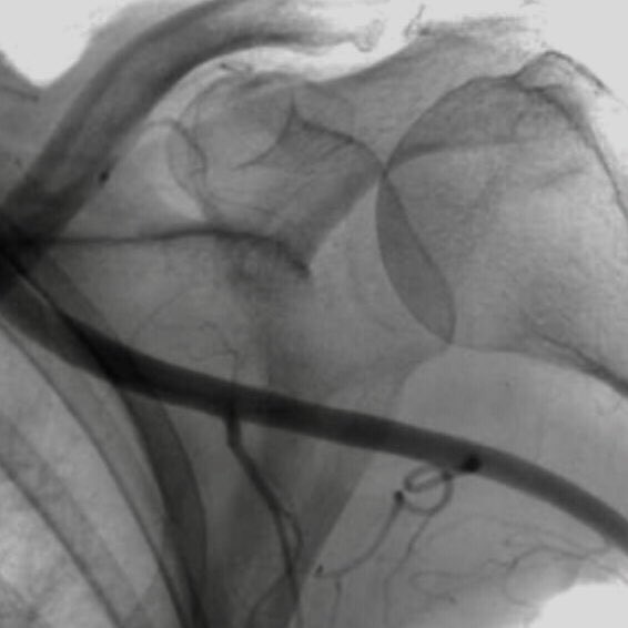 willsuh76's tweet image. #PercAx #TAVR. Single Perclose. Dry closure. Post angio showed mild extravasation.  Ten minutes manual pressure and repeat angio was pristine. No Perclose Pinch. No need for covered stent.