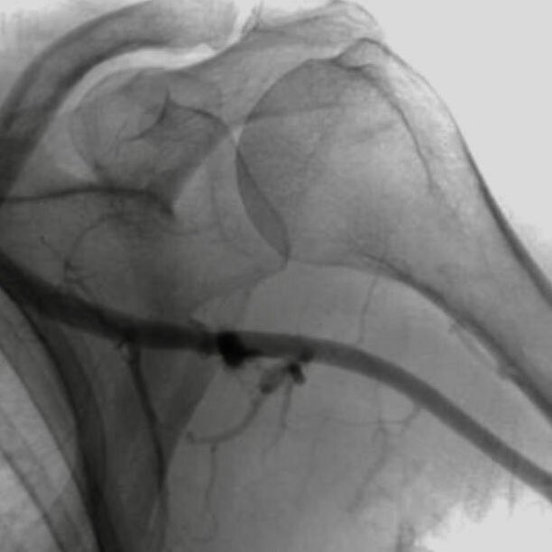 willsuh76's tweet image. #PercAx #TAVR. Single Perclose. Dry closure. Post angio showed mild extravasation.  Ten minutes manual pressure and repeat angio was pristine. No Perclose Pinch. No need for covered stent.