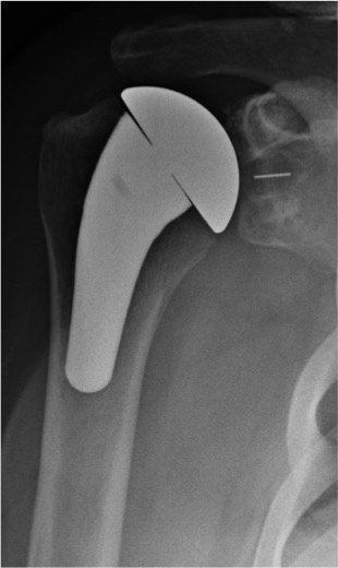 TERFSES's tweet photo. Congratulations to @TERFSES fellow @BenderOrtho on acceptance of podium presentation for @AAOS1 @ASESmembers Specialty Day 2019 and poster for ASES Closed Meeting 2018.  Results of total shoulder arthroplasty for instability arthropathy in patients following coracoid transfer https://t.co/oCBos8dp1z