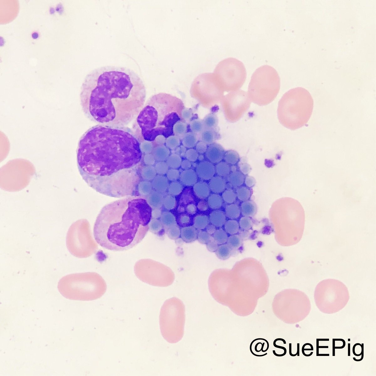 SueEPig's tweet photo. Mott cells are plasma cells characterized by an accumulation of multiple globular inclusions (Russell bodies) composed of immunoglobulin #hhpath #hemepath #mottcell #grapecells https://t.co/tcTZCtN3Jb