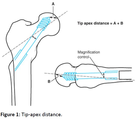 bone_reports's tweet photo. @A Comparative Study to Assess the Preoperative Thickness of Lateral Trochanteric Wall as a Predictor of Postoperative Lateral Wall Fracture: Article By: Sunku et al.
https://t.co/DEUIaLBLLH
Submission open for upcoming issue@
https://t.co/X6luJdOLgA https://t.co/D8qZg8wcXC