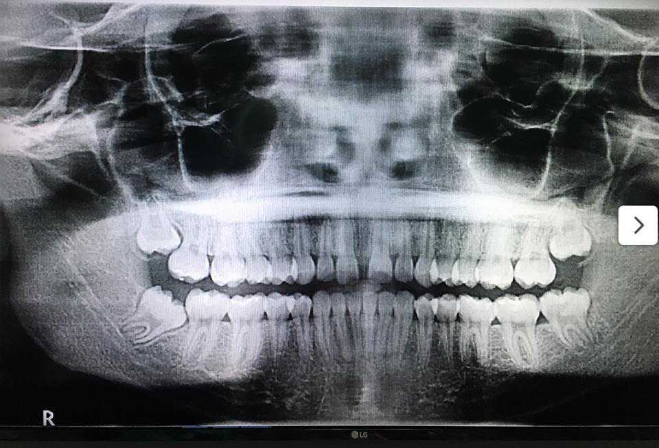 DrPorchia's tweet photo. Don’t suffer with #wisdomteeth pain! Call your friendly Oral Surgeon for all of your Oral Surgery needs! 👩🏿‍🔬💟😁#friscotx #littleelmtx #impactedteeth #oralsurgery #sedation https://t.co/0HVifkD6hU
