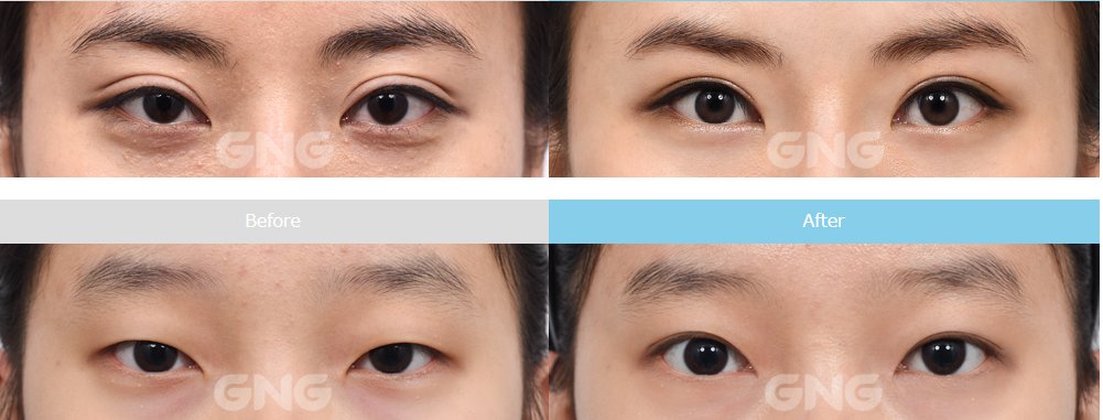 韓国gng病院 美容外科 目整形の症例写真のご紹介です 二重幅が広く不自然で眠たく見える目もすっきりとした自然 な二重にできます 自然ではっきりとした目に変化させてください ｇｎｇ ｇｎｇ病院 美容整形 整形 韓国 韓国整形 目整形