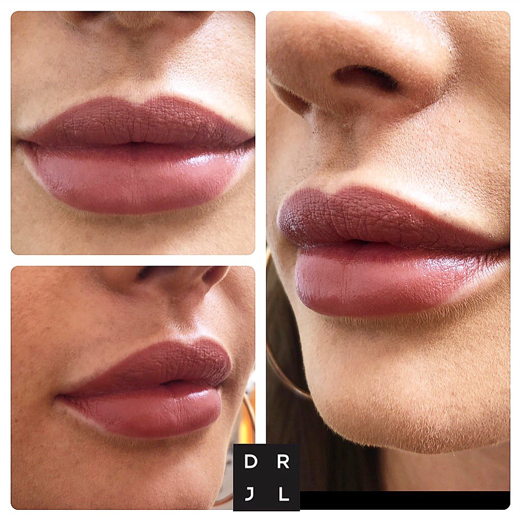 Lip Building 👄 Lips like these are not made in one day. 
To achieve the most natural results, in the safest way & still get the glamour, they need to be steadily built up over time #lips #naturallip #doctor #lipfillers
