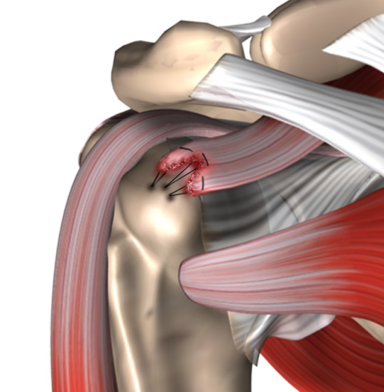 Разрыв ротаторной. Ротаторная манжета плеча тендинит. Кальцифицирующий тендинит плеча. Дебридмент плечевого сустава. Мышцы ротаторной манжеты манжеты.
