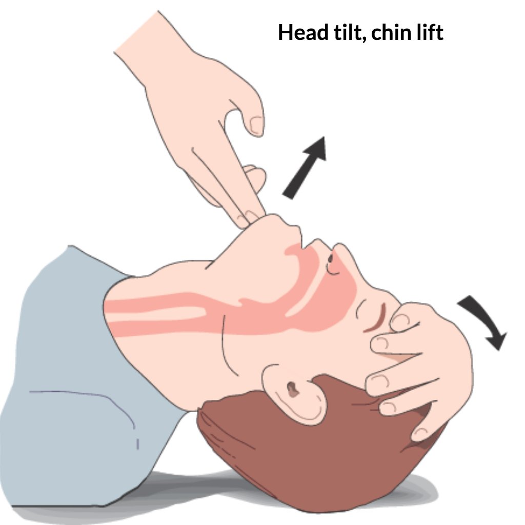 firstaidadvice's tweet photo. Simple airway manoeuvres SAVE LIVES! #jawthrust #headtiltchinlift #cardiacarrest #firstaid #firstaider #firstresponder https://t.co/Af6eYFiH8r