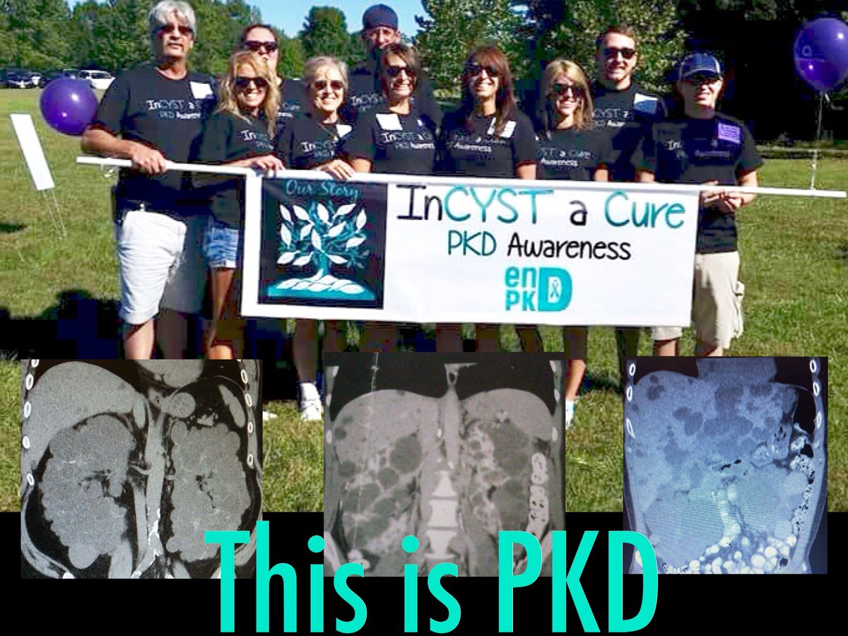 PaulaBrowning77's tweet photo. They say don’t judge a book by its cover, that’s goes for those of us living with PKD as well.We may look healthy and happy on the outside,but there are some days we feel miserable on the inside.Will you help the @PKDFoundation by donating to my Walk?
https://t.co/cyVSR89joc https://t.co/0lwkP80B9e