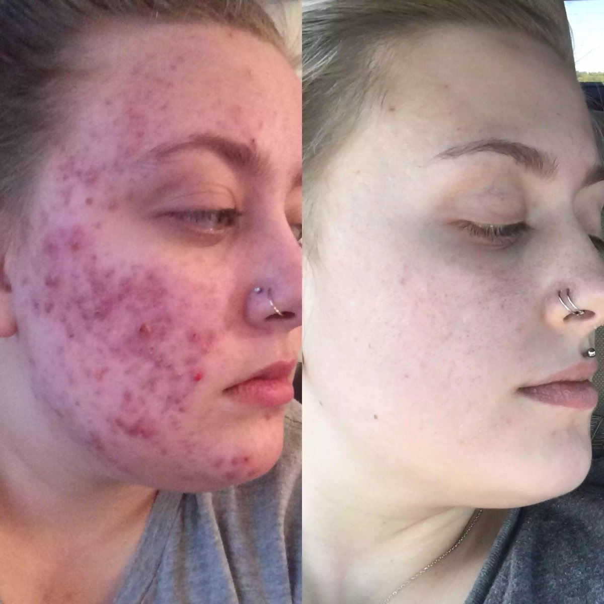 retin a cystic acne