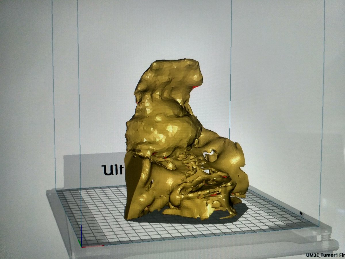 BiomMarina's tweet photo. Anatomical model of a tumor found at the sacrum printed at @3d_maranon using @Ultimaker 3. It will be very useful for surgery planning. @CristinaLopezSe  @rupermac @calvoharo_ja #3Dprinting https://t.co/cFEI01RSPW