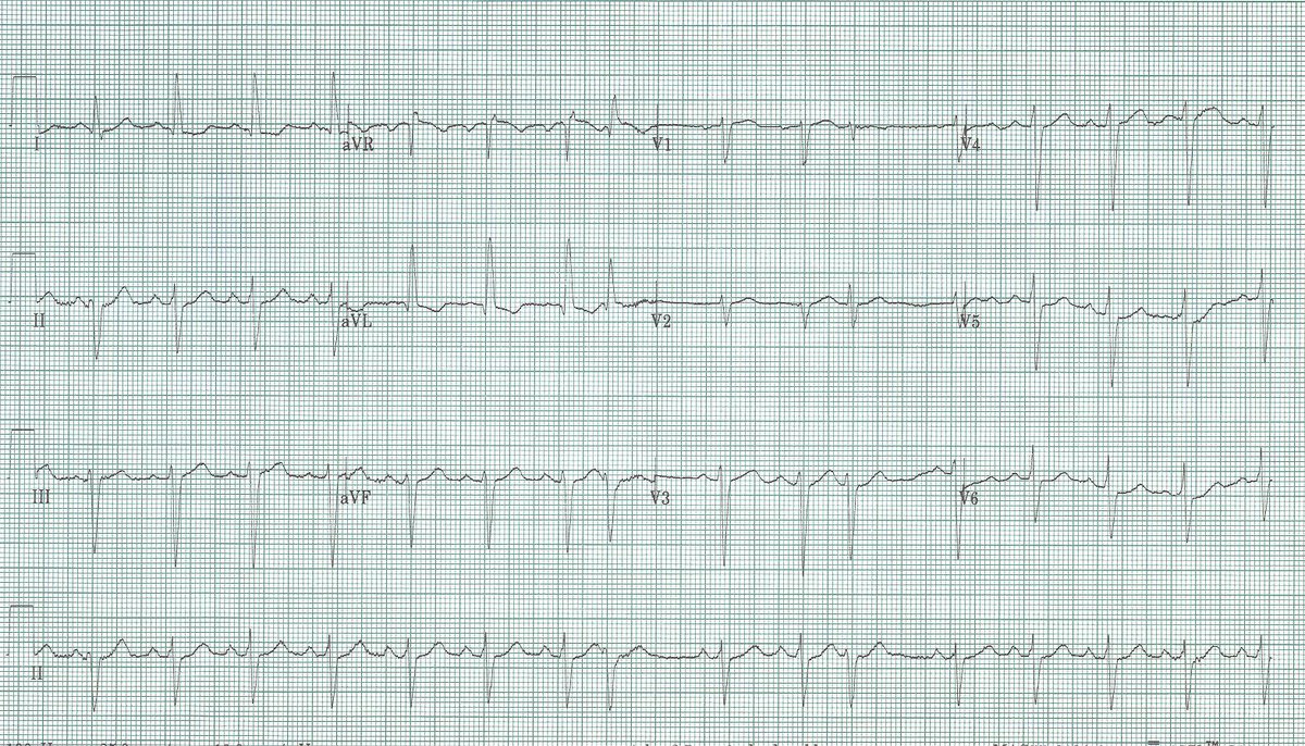STorreyMD's tweet photo. EKG of the Week #57
What is the etiology of the two premature beats seen here, and why?
see https://t.co/2xtiqsN3vu for answer and discussion https://t.co/YHkGfSWu0z