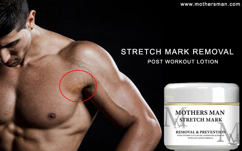stretch marks men removal