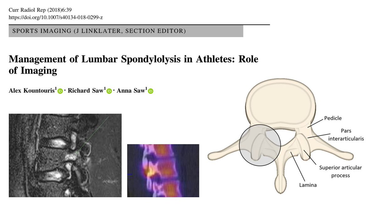 New paper: Management of Lumbar Spondylolysis in Athletes: Role of Imaging
#spine #pars #stressfracture #MRI #cricket

em.rdcu.be/wf/click?upn=l…