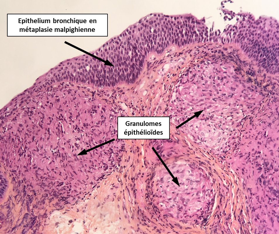 2cAnapath's tweet photo. Identification de granulomes épithélioïdes et gigantocellulaires dans le chorion, ces aspects sont compatibles avec une sarcoïdose. https://t.co/NCJ2yV0lpA