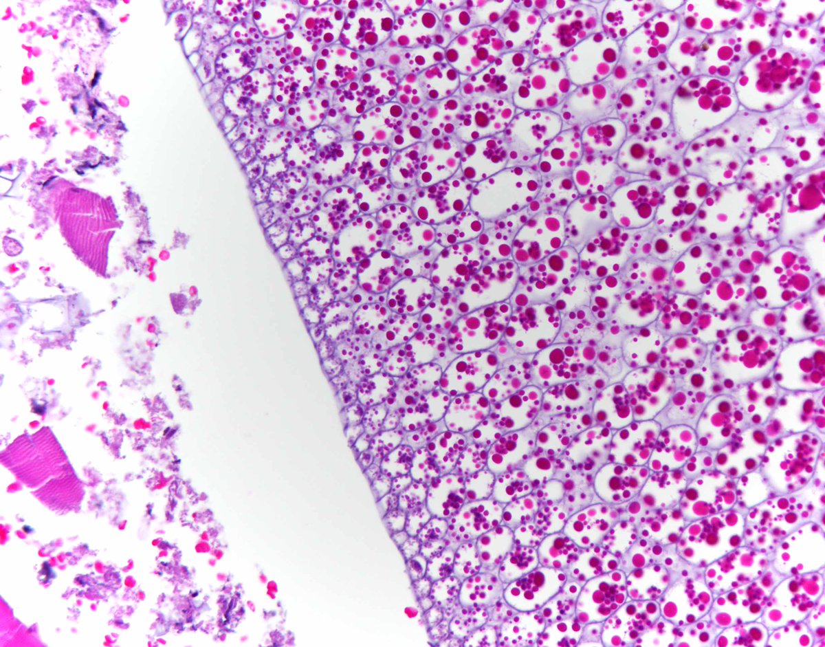 Image of the day: shotgun wound of head. Section of scalp with embedded bone fragments (left) and synthetic material found in wound (right), likely a component found within the shotgun shell. #forensic #pathology #PathArt #histology