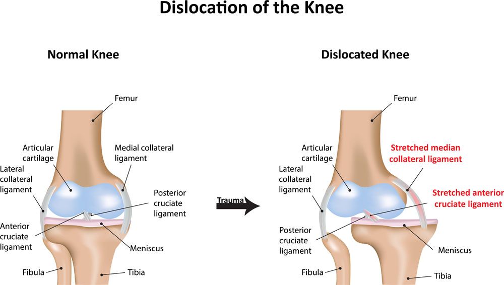 LASportsOrthoMD's tweet image. An ER visit is highly recommended in cases of a #kneedislocation. If a dislocation is present, an orthopedic specialist will reduce the knee in the correct position by gentle manipulation. medilink.us/um8d