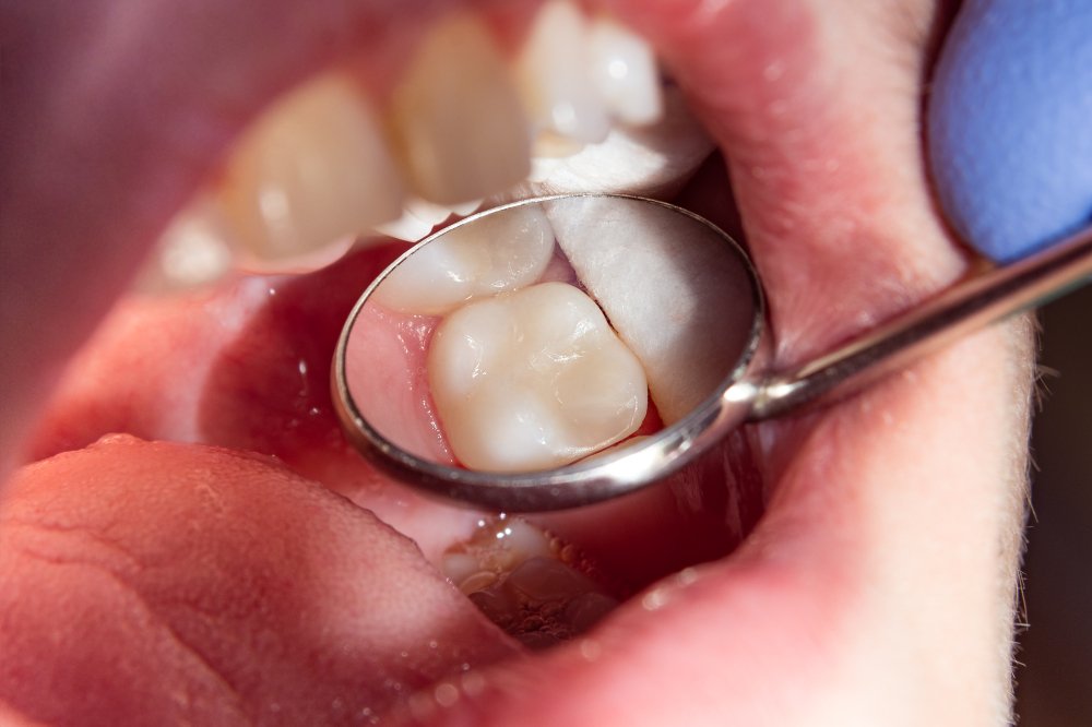 bridgestdental's tweet photo. Q - What type of dental filling material do we use?
A - White Fillings Only - Light Activated Composite Material. We do not place amalgam (silver) fillings here. Want to learn more? Click https://t.co/3JD13MOLZt
#WhiteFillings #SilverFillings #Cavities #ToothDecay #HealthySmiles https://t.co/e9uUGrJO1W