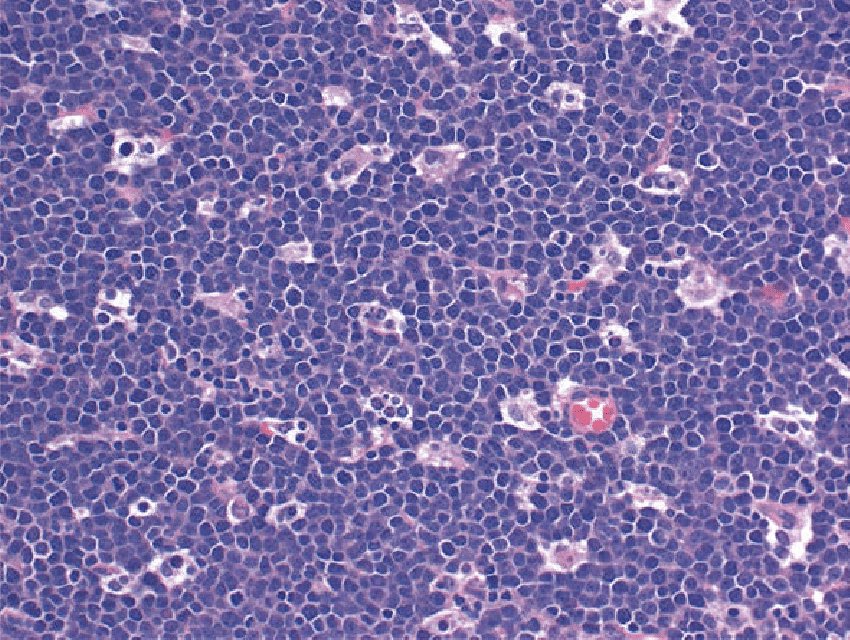  #lymphomafacts - Burkitt-3Classic germinal centre derived:- CD10+ BCL2- (or weak), BCL6+, CD20/79a+- medium sized blastic cells- most rapidly prolif cancer known to man: prolif index 100%- ‘starry sky’ histology: tumour cells the dark sky; tingible body macrophages #lymsm