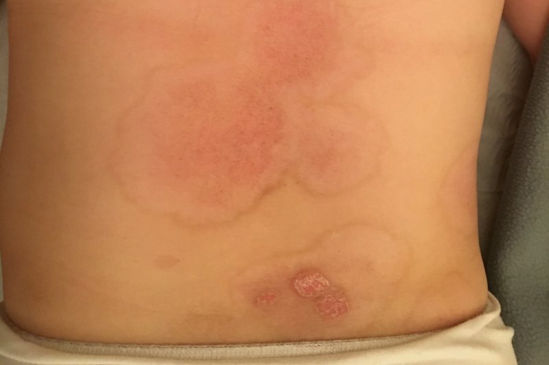 'I now have over 95% clear skin and I can go swimming without being self-conscious about my appearance.' Read more from the latest of our '50 for 50' stories, written by an anonymous author: ow.ly/KbE630k4fNP #psoriasis #skin