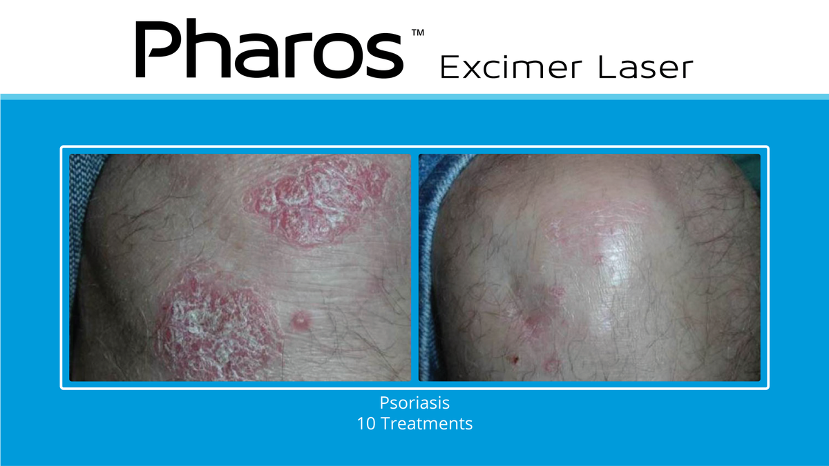 PharosLaser's tweet photo. Ask your #dermatologist about Pharos for #psoriasis, #AtopicDermatitis, and #leukoderma, and how to restore your confidence and quality of life. https://t.co/fiWz2puqSx