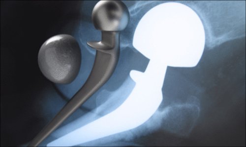 Federal Judge Finalizes Johnson & Johnson #HipInjury Plaintiffs' Award of $245 Million Over #Defective #DePuyPinnacle Metal-on-Metal #HipImplants in #Bellwether Case lieffcabraser.com/2018/08/federa…