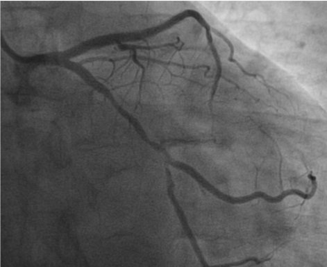 CRMjournal's tweet photo. Article in press: #Outcomes after #atherectomy #treatment of #severelycalcified #coronary #bifurcationlesions: A #singlecenter experience by Jeffrey W. Chambers et al. in July/August issue https://t.co/alAeEdKz6M https://t.co/D3srYoz5Mj
