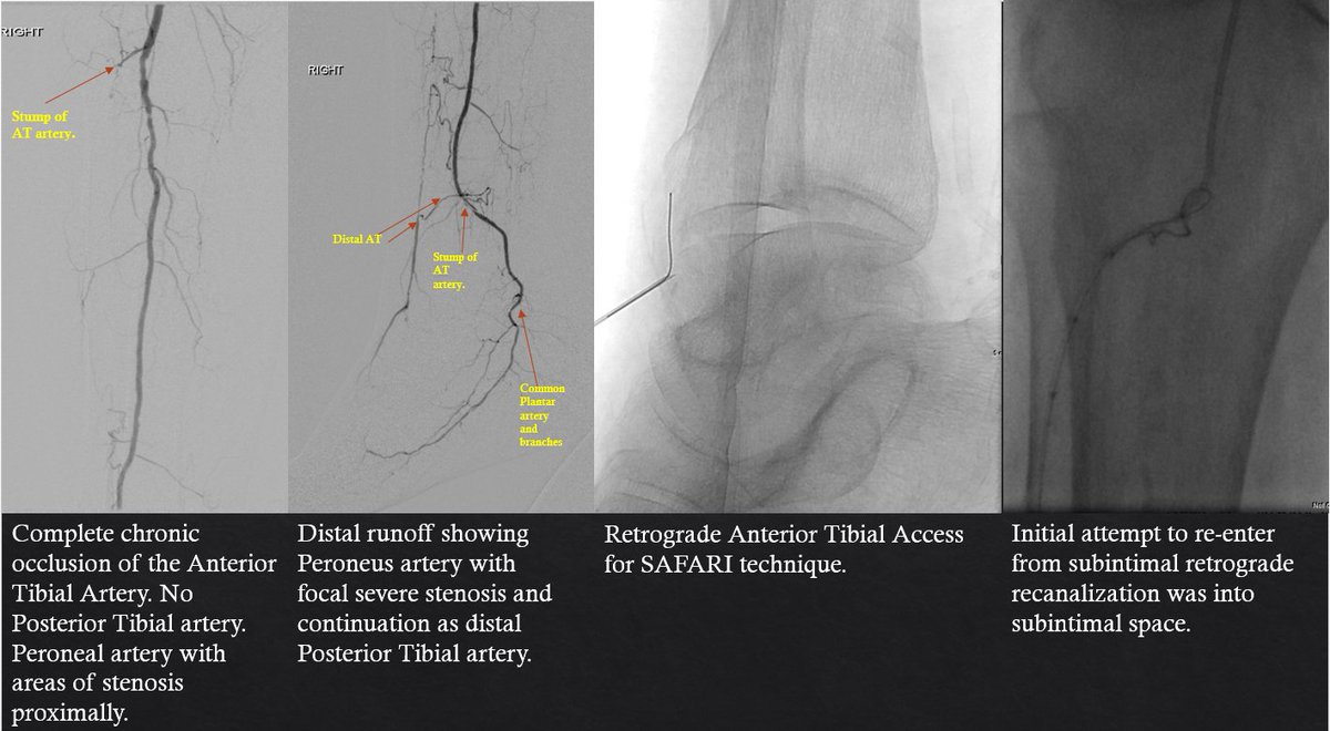 kmadass's tweet image. #MyLegMyLife means spending the time and resources to give every patient a chance at limb preservation. #Clifighters @monteromiguel @LessneVIR @Watts_IR @SOBE_Vascular @AlexCVIR @SDhandMD @DanHan @Vascularman @FadiSaab17 @Mustapja @surgmax @UTHouston_IR @drsavealimb @ahmedkayssi