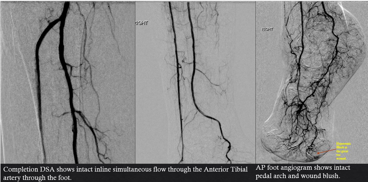 kmadass's tweet image. #MyLegMyLife means spending the time and resources to give every patient a chance at limb preservation. #Clifighters @monteromiguel @LessneVIR @Watts_IR @SOBE_Vascular @AlexCVIR @SDhandMD @DanHan @Vascularman @FadiSaab17 @Mustapja @surgmax @UTHouston_IR @drsavealimb @ahmedkayssi